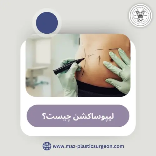 جراحی لیپوساکشن
