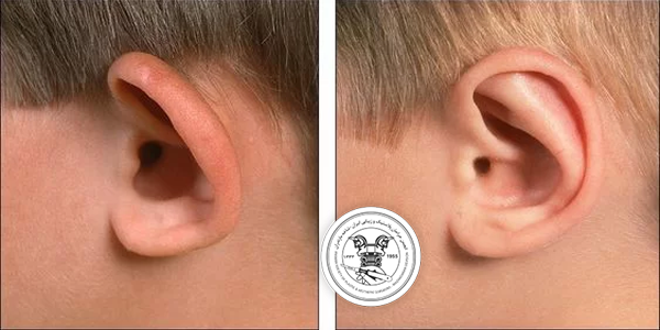 عوارض جراحی زیبایی گوش