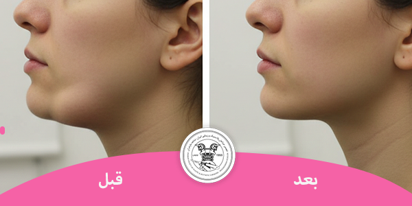لیپوماتیک غبقب کاندید