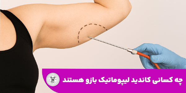 چه کسانی کاندید لیپوماتیک بازو هستند