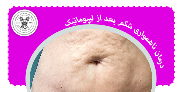درمان ناهمواری شکم بعد از لیپوماتیک