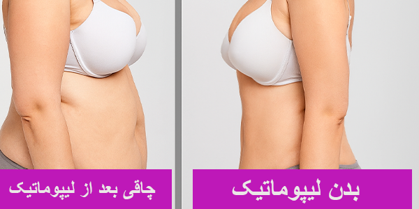 عکس چاقی بعد از لیپوماتیک