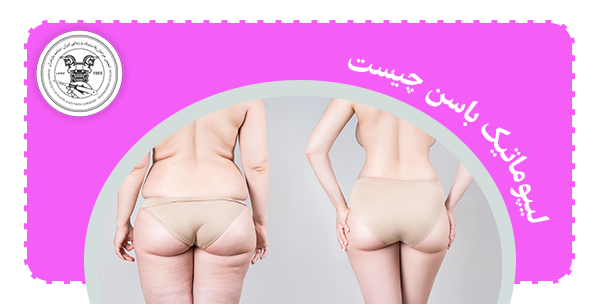 لیپوماتیک باسن چیست