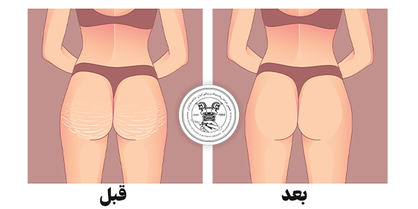 نمونه لیپوماتیک باسن