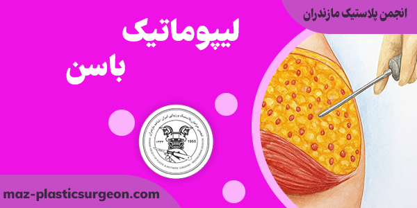 چه کسانی کاندید لیپوماتیک باسن